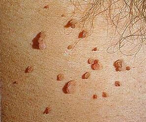 մարդու պապիլոմավիրուսը մաշկի վրա